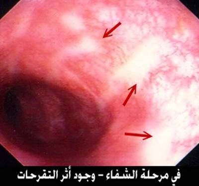 ���� Crohn`s Disease